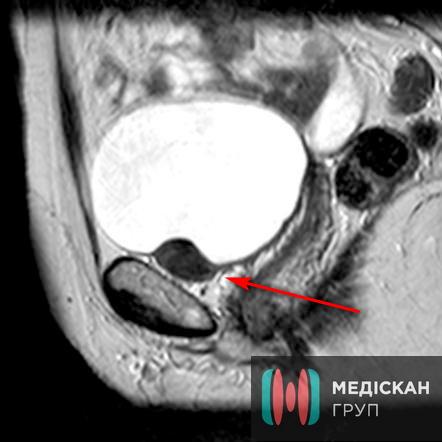 мрт мочевого пузыря